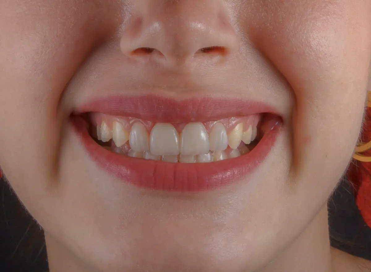 Teeth whitening
